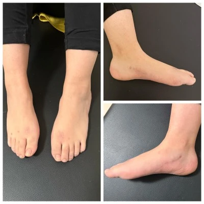 Şanlıurfa&rsquo;da Nadir Hastalığa Doğru Tanı: &Uuml;&ccedil; Kardeş Yeniden Y&uuml;r&uuml;meye Başladı